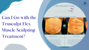 Trusculpt Flex Muscle Sculpting